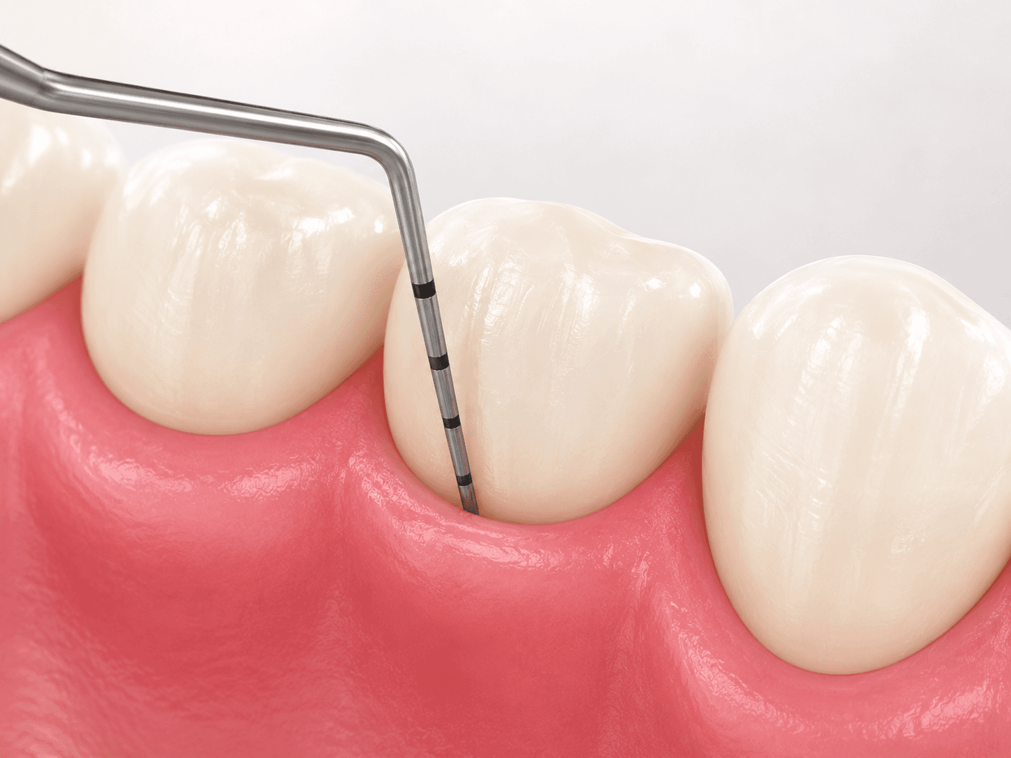 Periodontoloji (Diş Eti Hastalıkları)